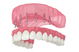 Illustration of ball-socket implant dentures with white background